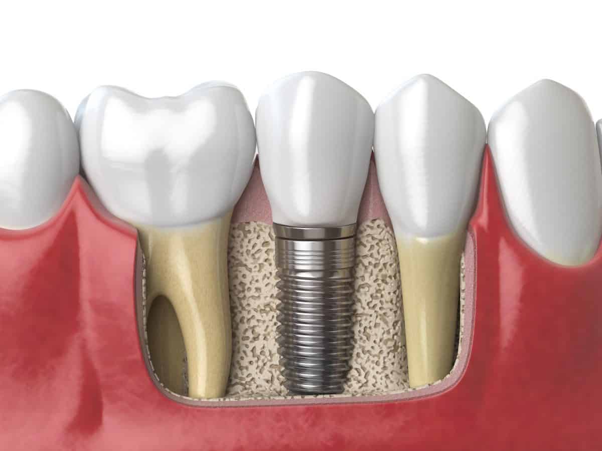 Dental Implants Arlington Advanced Dental Care