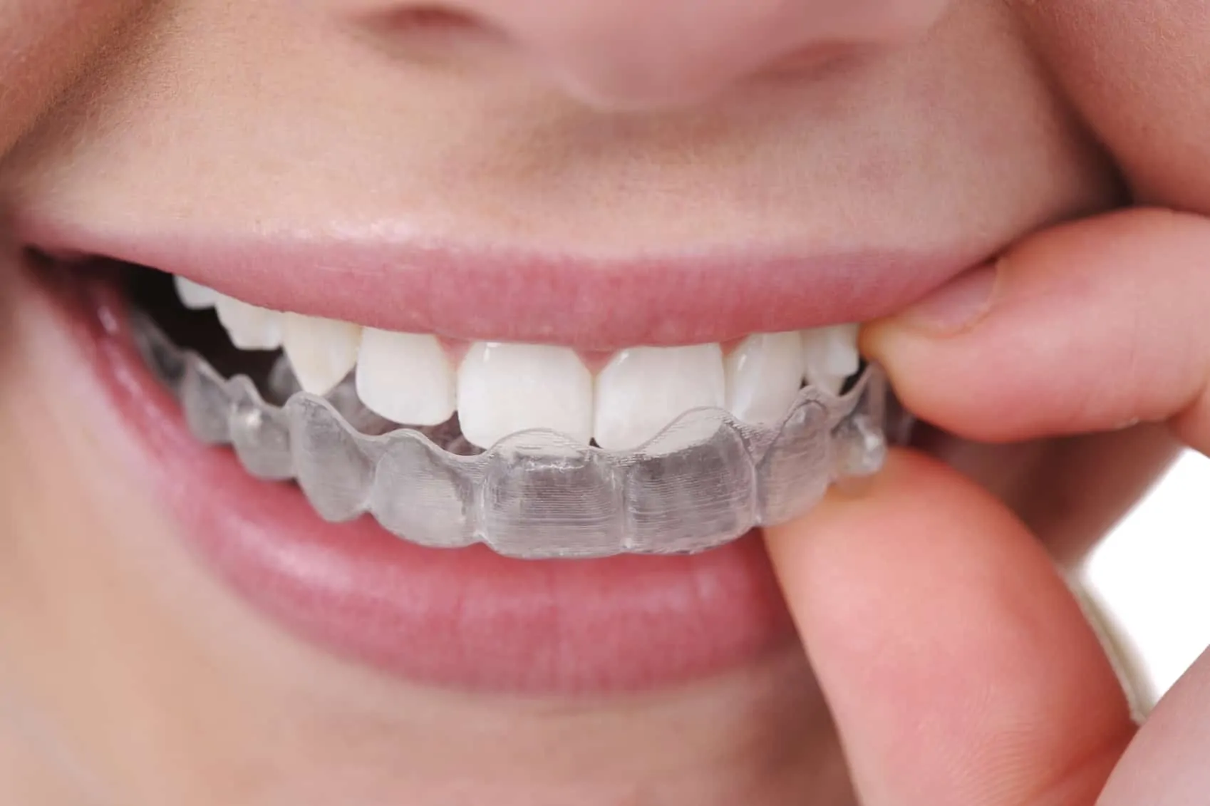 invisalign invisalign