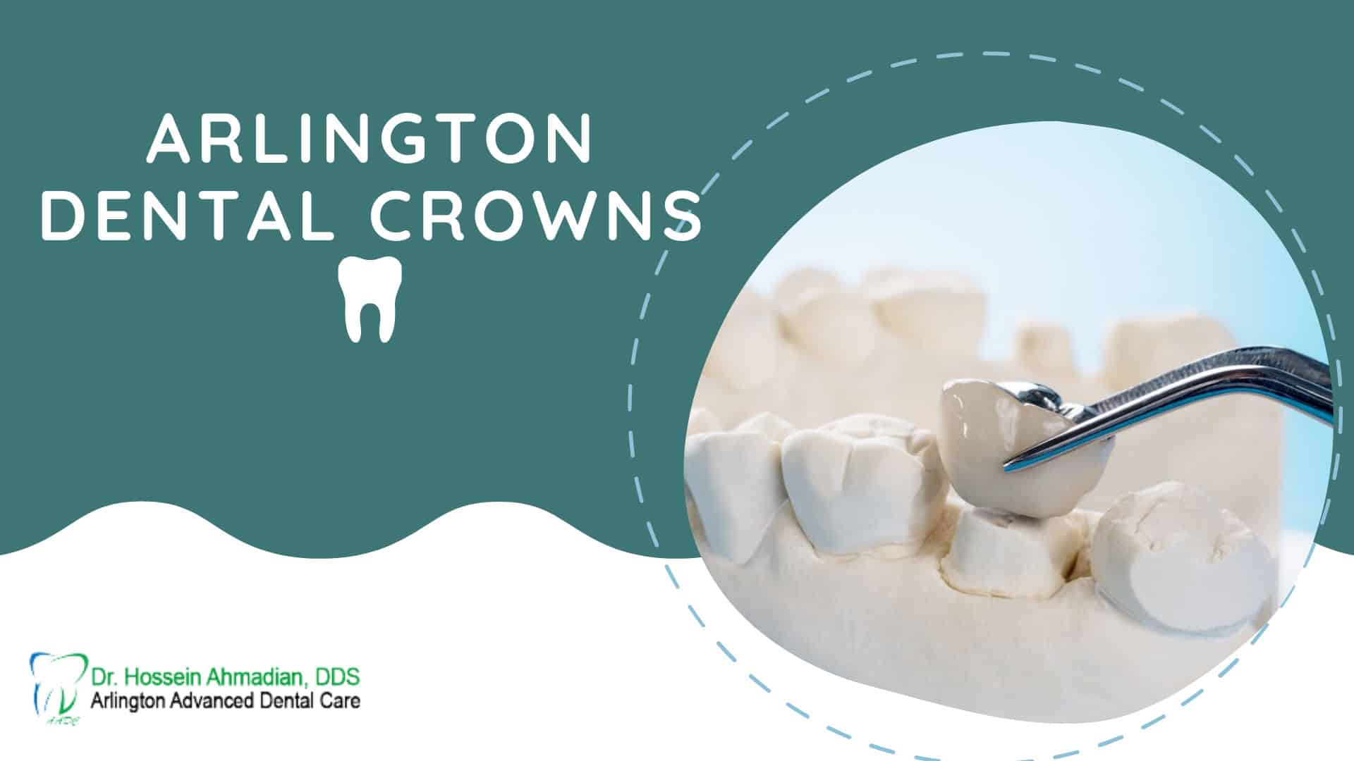 Arlington Dental Crowns Arlington Advanced Dental Care